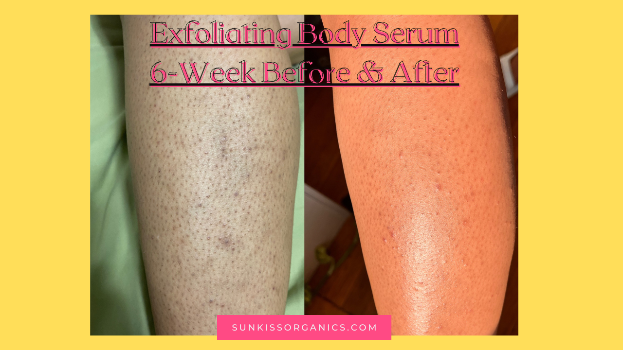 TRUE STORY Your girl has keratosis pilaris ingrown hair and